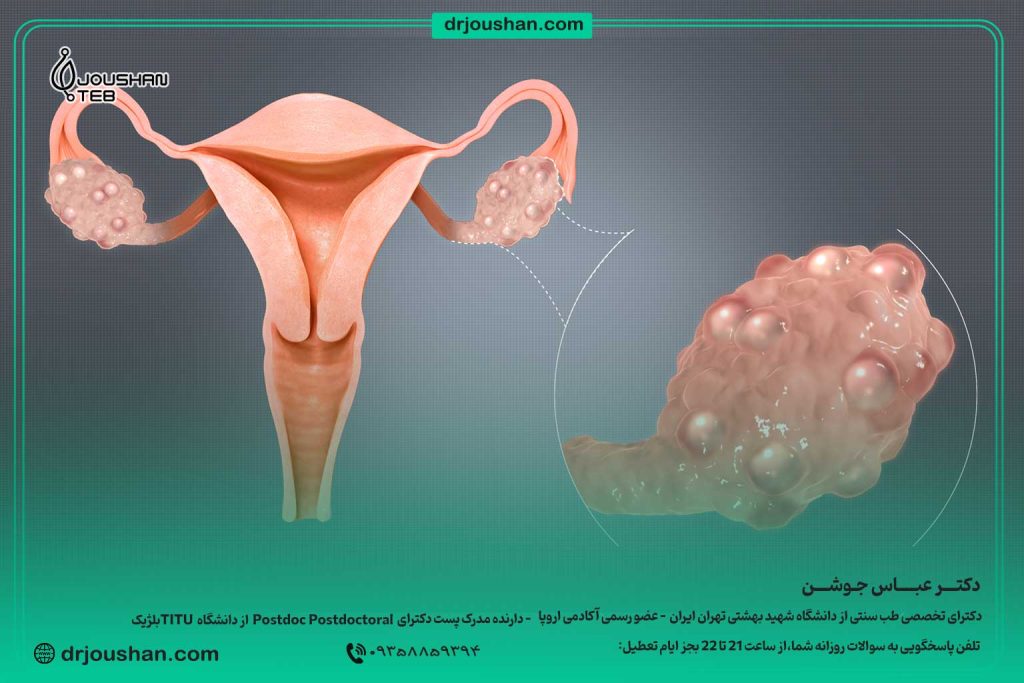 سندرم-تخمدان-پلی‌کیستیک--درمان-و-سردی-رحم(PCOS)