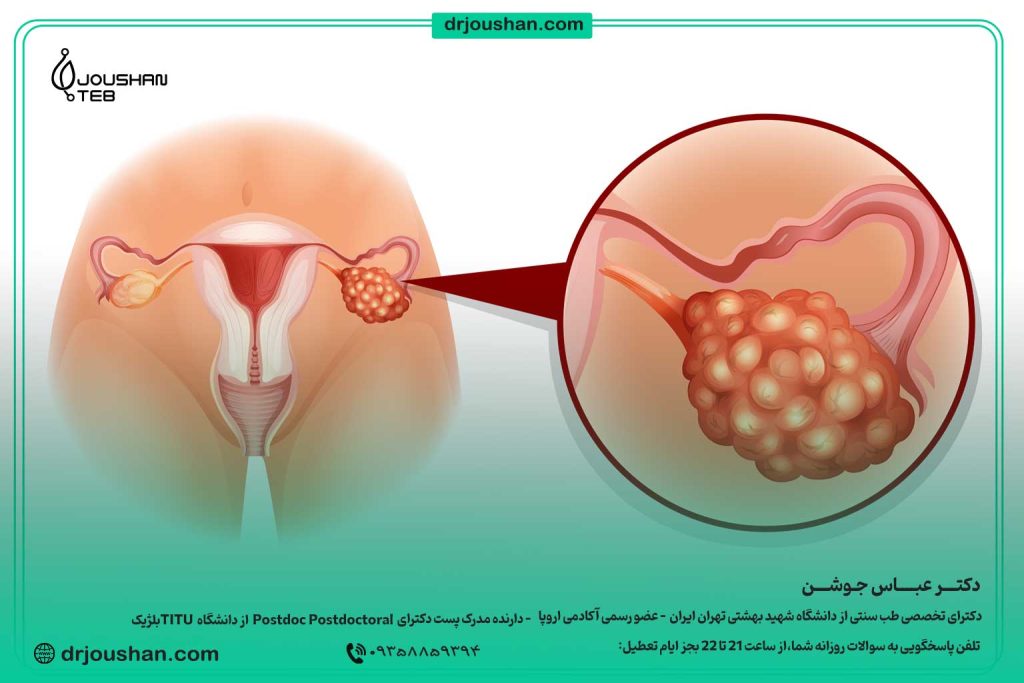 سندرم-تخمدان-پلی‌کیستیک--درمان-و-سردی-رحم(PCOS)-دکتر-عباس-جوشن