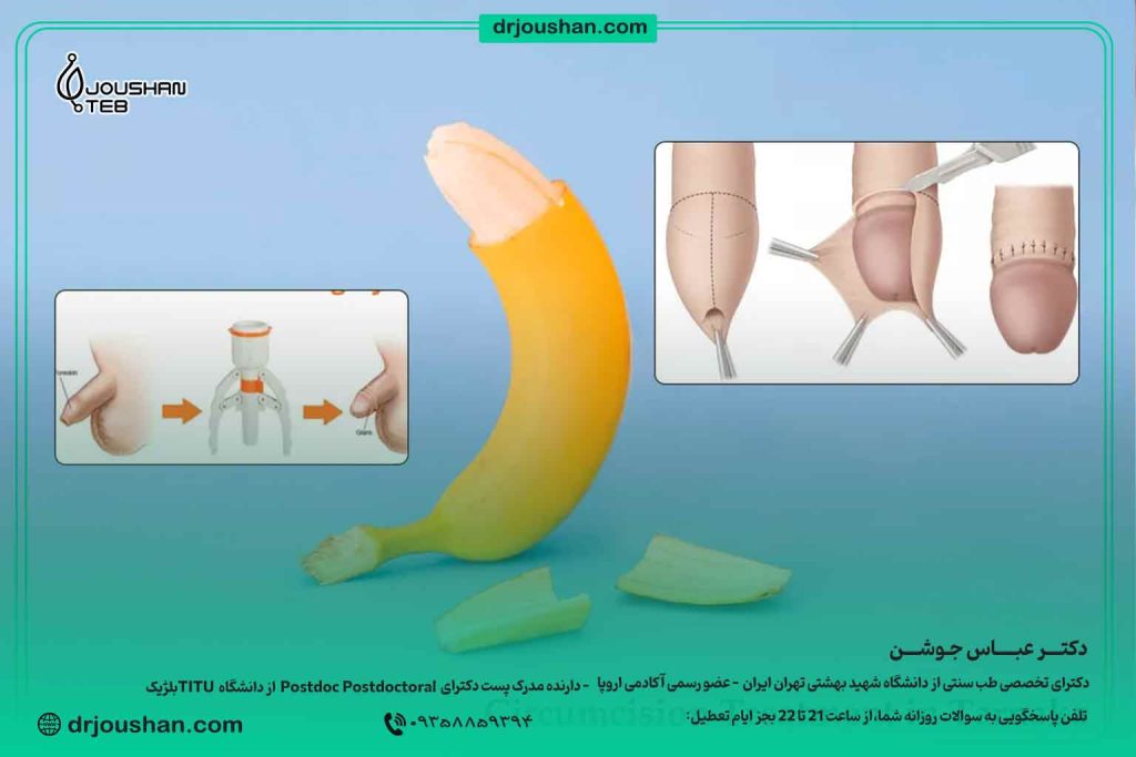 غذای-بعد-از-ختنه-دکتر-عباس-جوشن