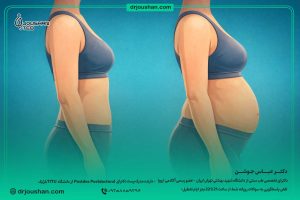 آب-کردن-چربی-شکم-در-کوتیزول-بالا-دکتر-عباس-جوشن