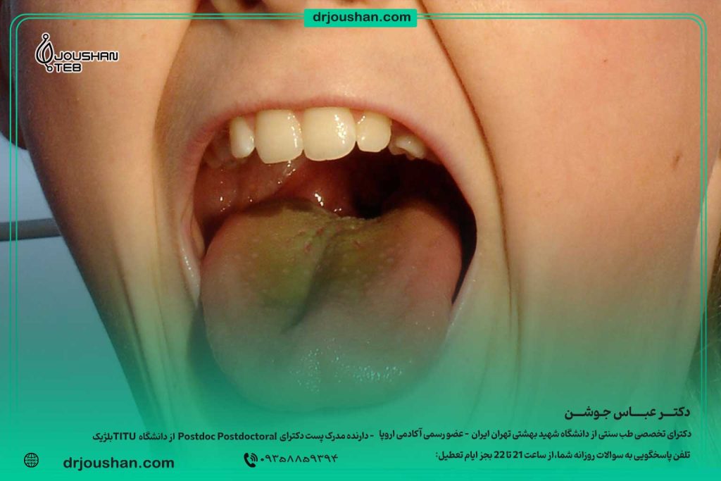 آموزش-ساده-تشخیص-بیماری-ها-از-روی-زبان-در-طب-سنتی-دکتر-عباس-جوشن