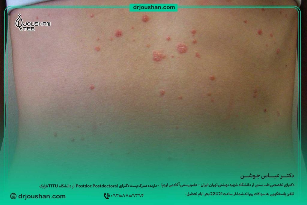 انواع-پسوریازیس-و-درمان-آن-در-طب-دکتر-عباس-جوشن-سنتی