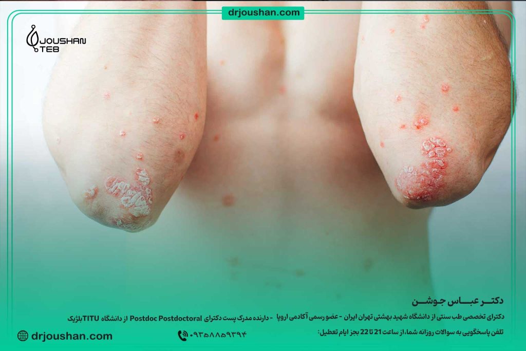تفاوت-پسوریازیس-با-اگزما-و-درمان-آن--دکتر-عباس-جوشن