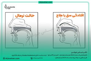 توضیح-کامل-افتادگی-سق-یا-افتادگی-ملاج-دکتر-عباس-جوشن