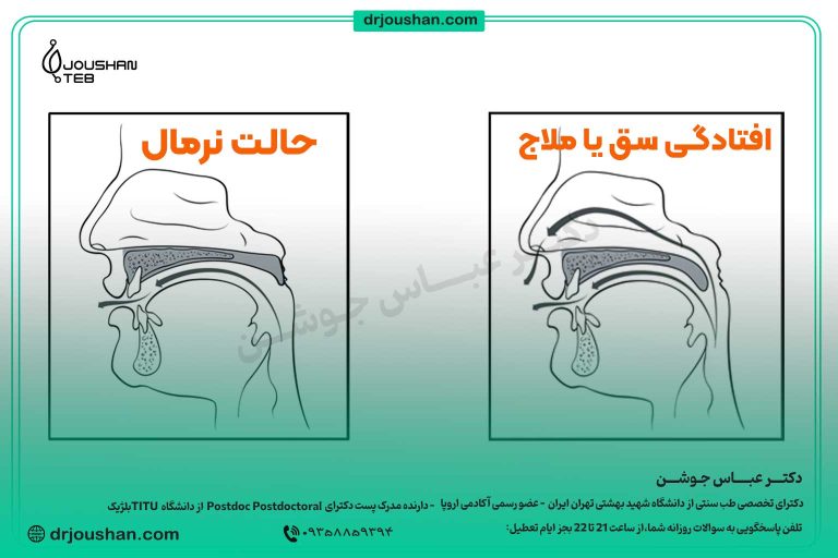توضیح-کامل-افتادگی-سق-یا-افتادگی-ملاج-دکتر-عباس-جوشن