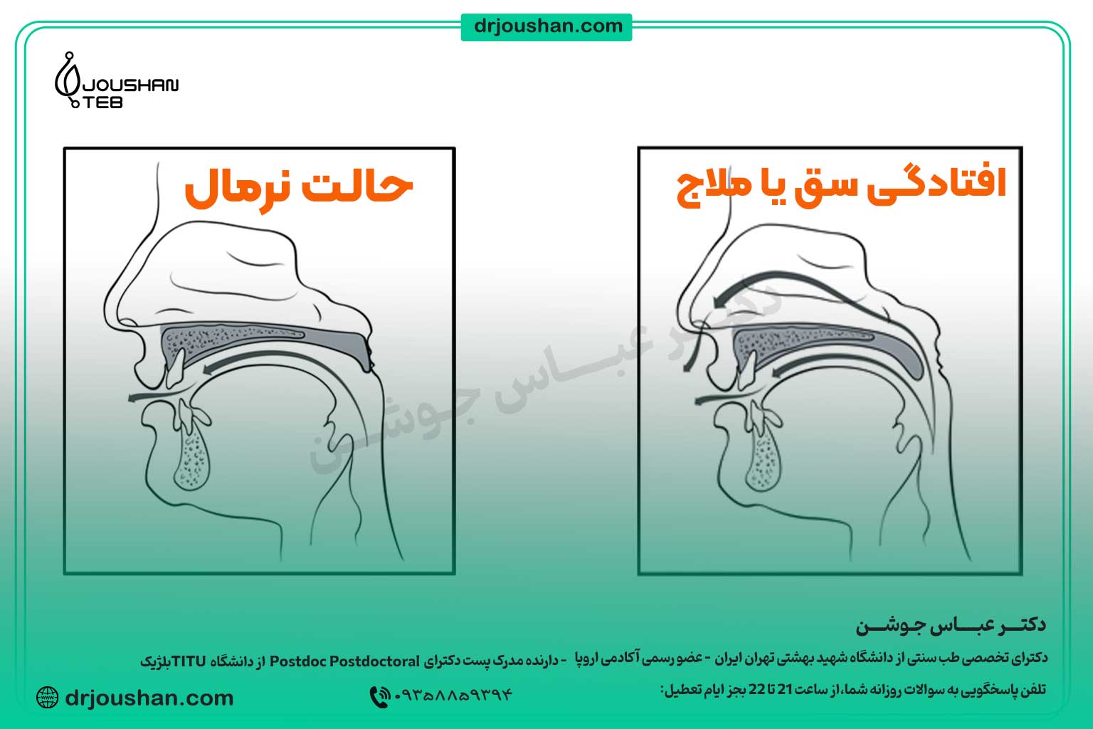 توضیح-کامل-افتادگی-سق-یا-افتادگی-ملاج-دکتر-عباس-جوشن