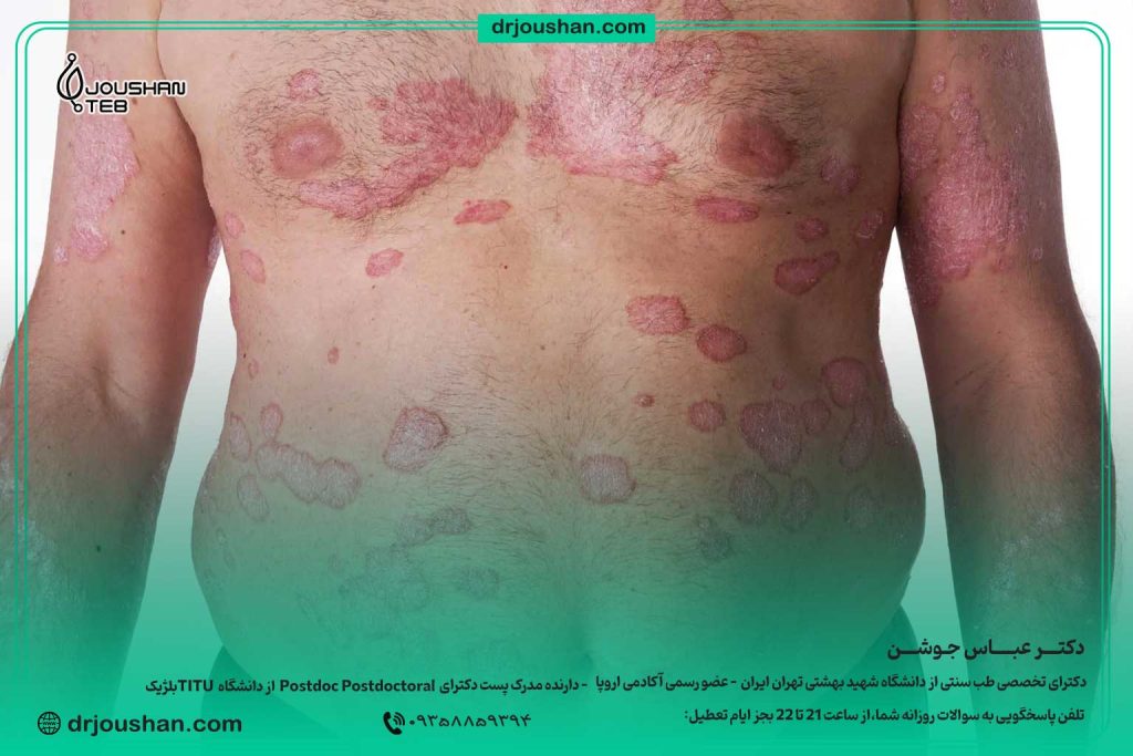 ۱۰-اصل-طلایی-درمان-پسوریازیس-در-طب-سنتی-دکتر-عباس-جوشن